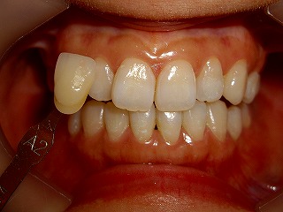 �V�F�[�h�e�C�L���O