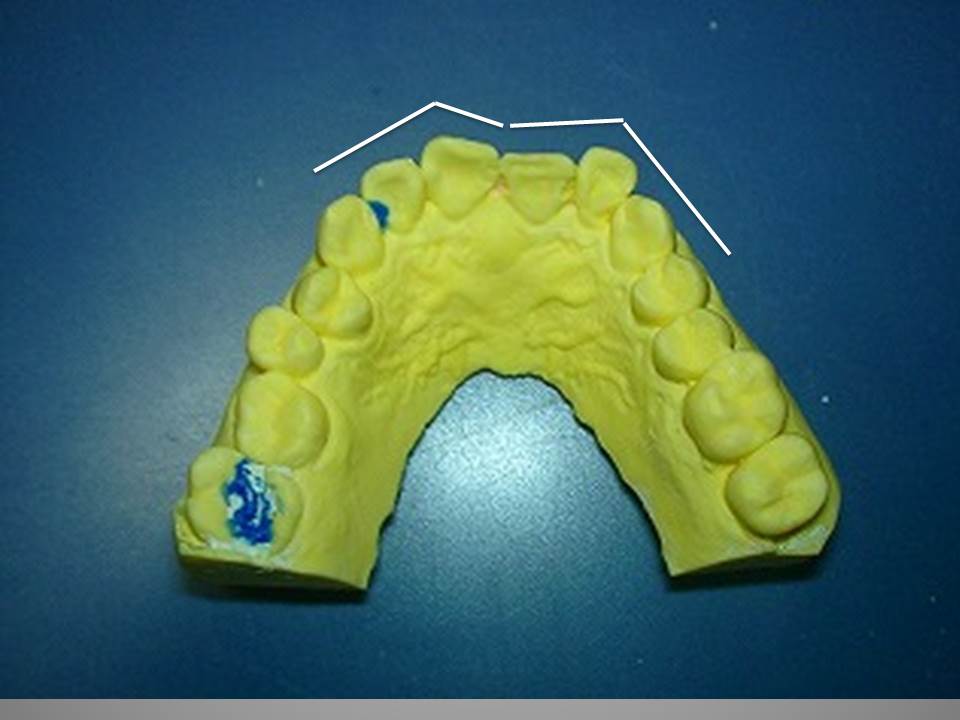 �A�N�A�����O(�����ʊ�)